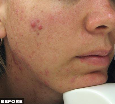 Post steroid acne treatment